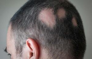 Top 5 Ursachen für Haarausfall