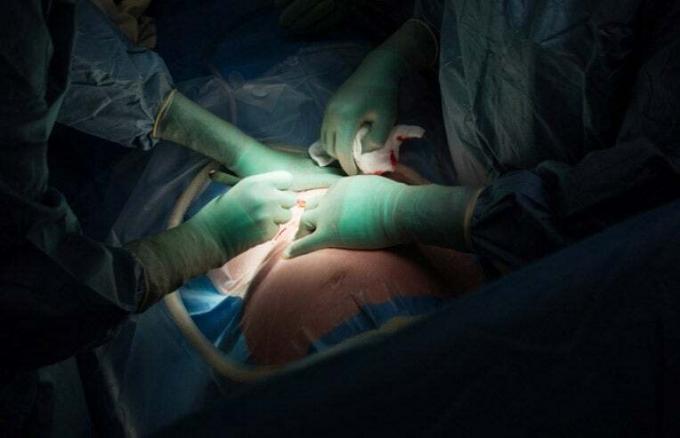 يقوم الجراحون بإجراء عملية قيصرية