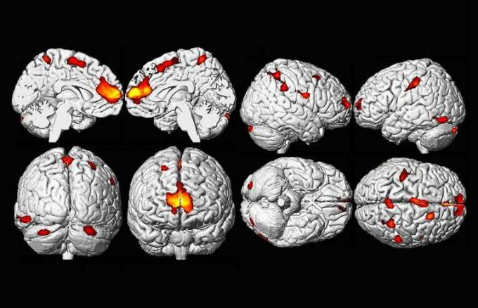 Snížený objem mozku v důsledku expozice olovu