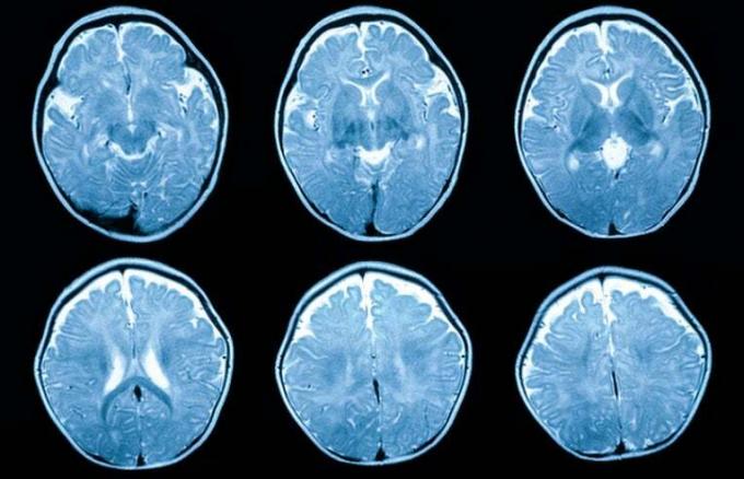 skeniranje možganov otroka